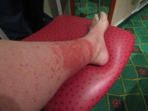Got a horrible leg rash from the heat