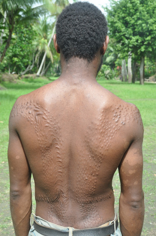 Scarring From Crocodile Initiation