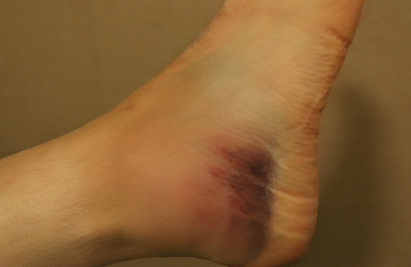 The residue of the sprain!