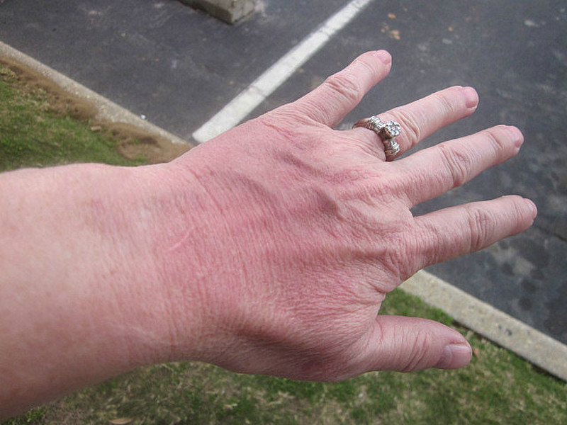 Yep, wear your gloves or use sunscreen....