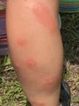 I win for the worst bug bites on the trip! 