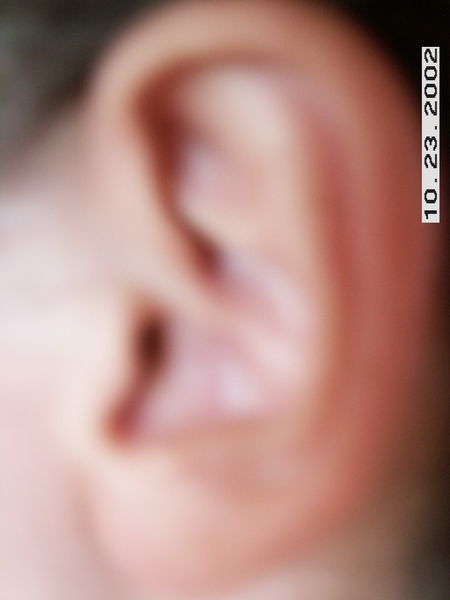 And this is my infected ear
