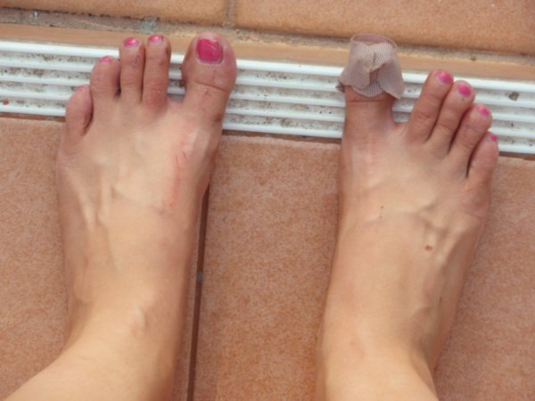 My battered feet