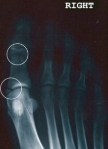 Kara's toe and the 2 breaks.