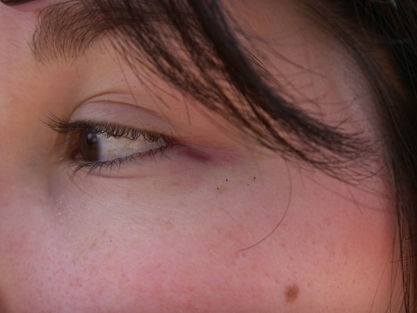 Purple vein by eye
