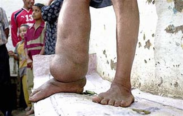 Elephantiasis - Photo Credit: http://science.discovery.com/top-ten/2009/infectious-diseases/infectious-diseases-09.html