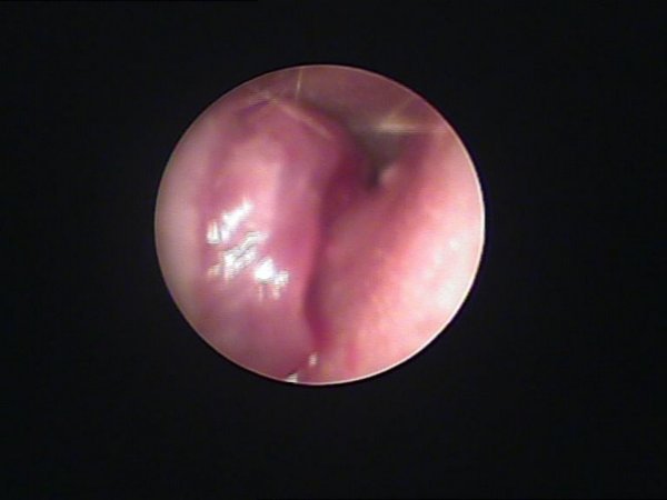 Right ear with abscess