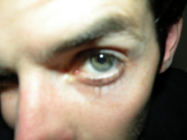 Fabrice's eye