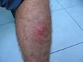 My leg Infection....Gross
