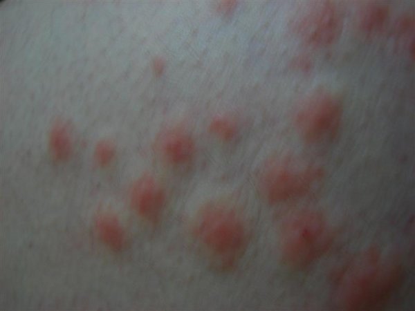 bed bugs bites images