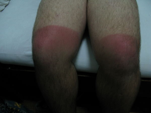 Burnt knees part 1
