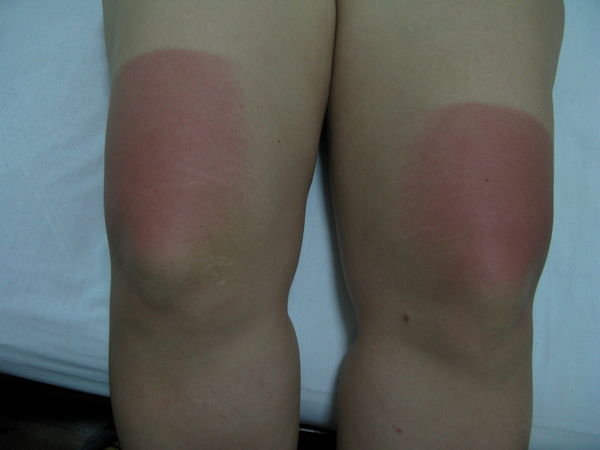 Burnt knees part 2