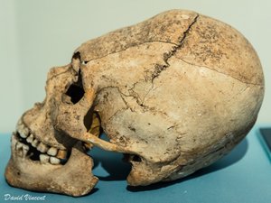 A Merovingian elongated skull