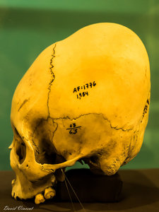Deformed Skull