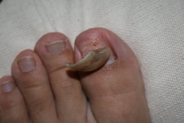 the demise of the toenail 2