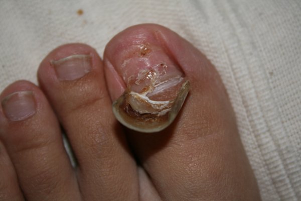 the demise of the toenail 3