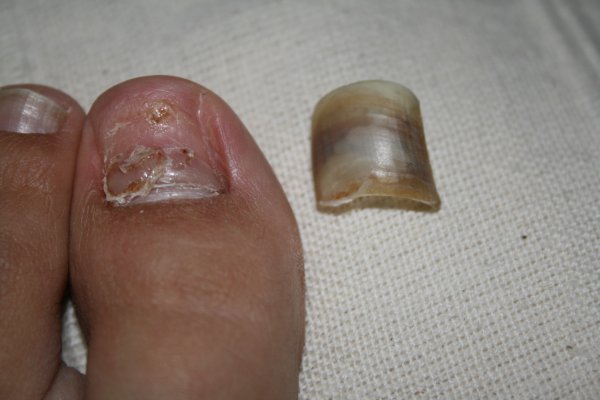 the demise of the toenail 4