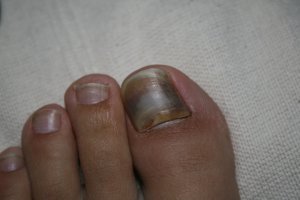 the demise of the toenail 1