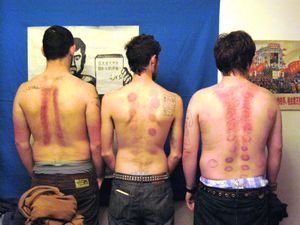 Cupping Welts