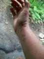 chichicaste poison ivy on my hand