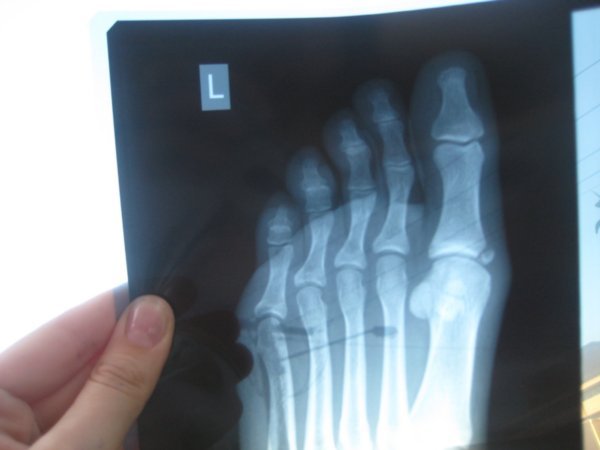 broken foot!