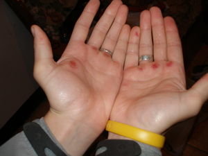 Hands After Day One