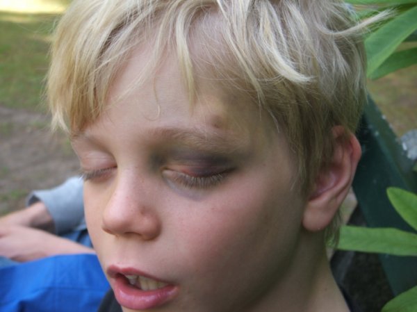 Thomas' black eye, day 5