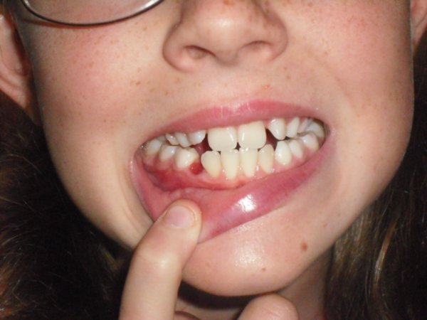 Annelies loses a tooth