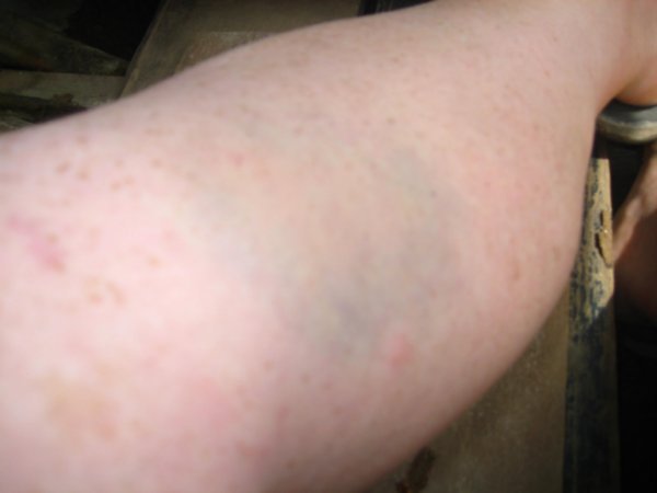 My bruise post near death bamboo experience!