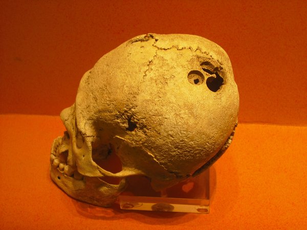 Skull with drill holes, as for brain surgery