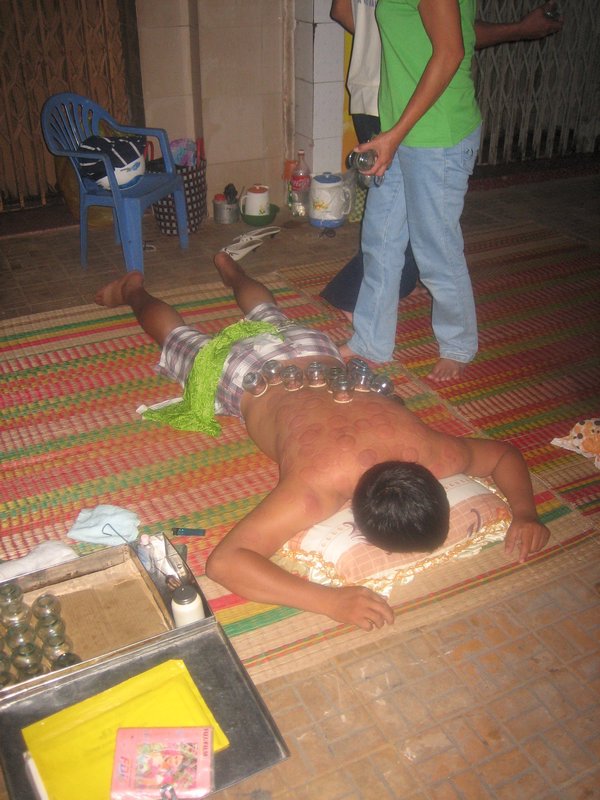 Man getting "cupped'