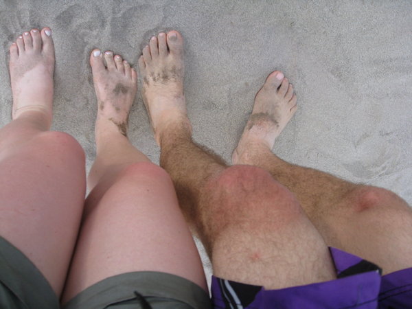 Sunburnt knees