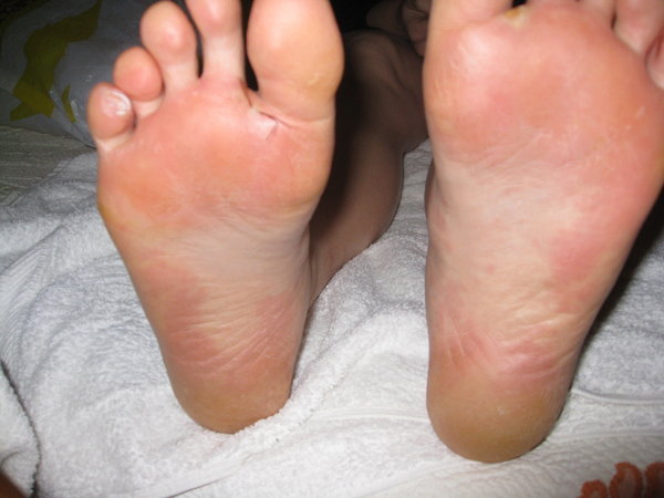 My swollen, red feet