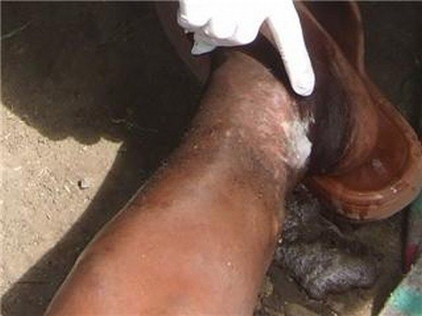 Tending to a serious infection on a man's leg