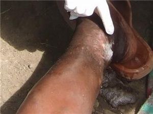 Tending to a serious infection on a man's leg