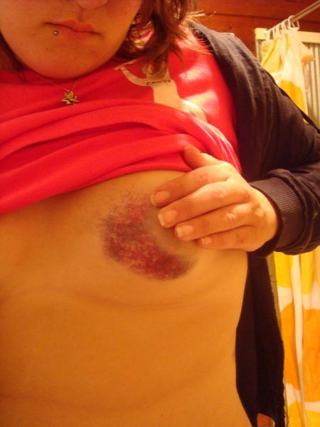 Yes, that is a bruise on my boob, and yes it did hurt....a lot.